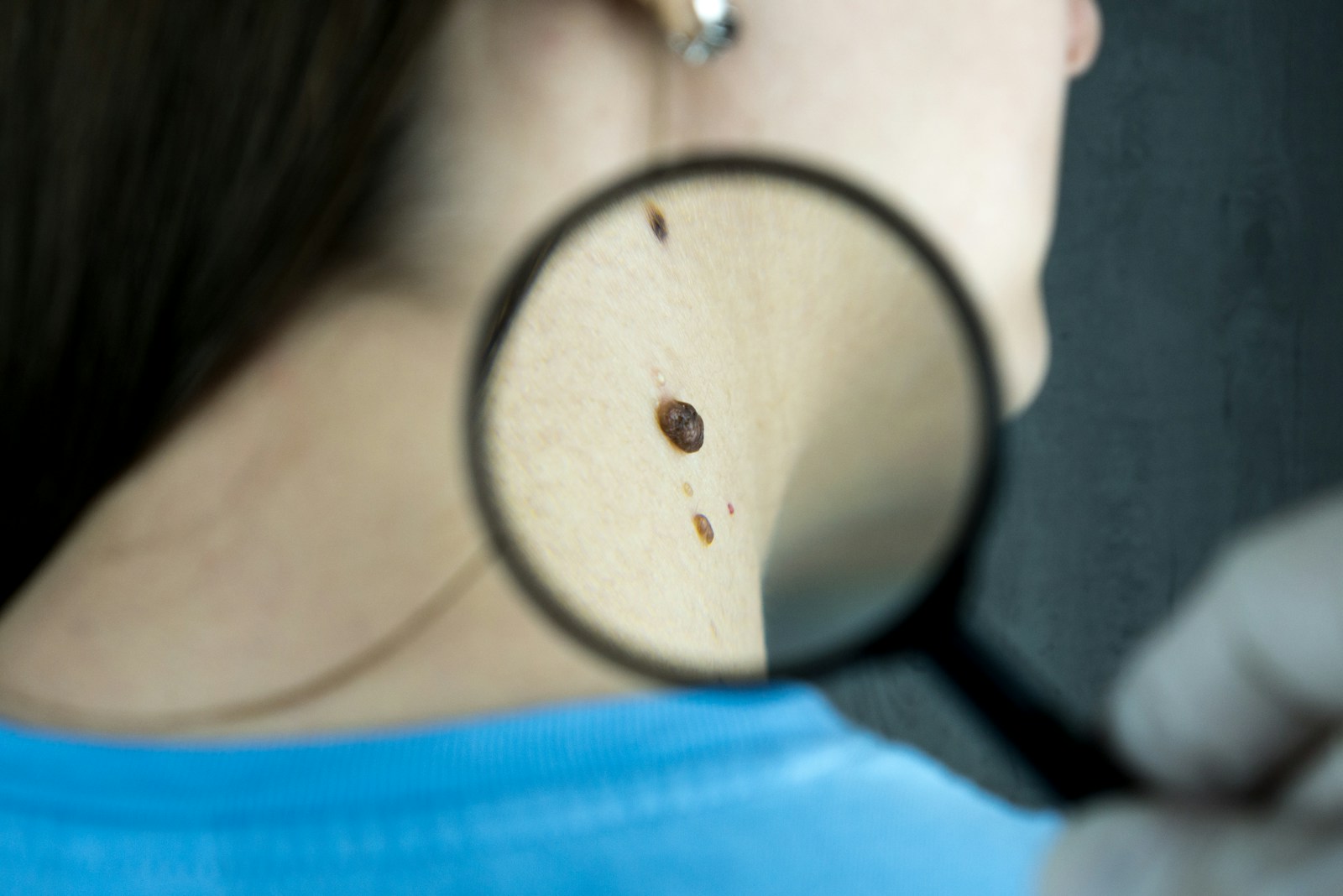 Jesień to dobry moment na dermatologa. Co skonsultować po lecie: znamiona, przebarwienia, trądzik?